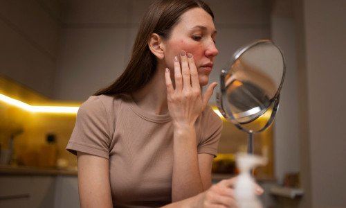 Що таке розацеа та як вчасно помітити перші симптоми